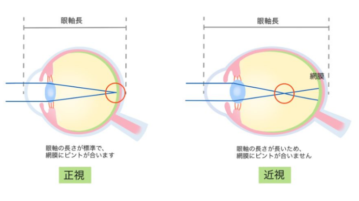 網膜剥離ってボクサーでなくても起こるんよね