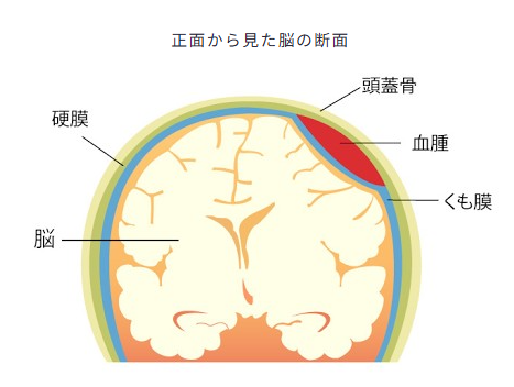 硬膜下血腫　その１